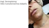 Mechaninių veiksnių taikymas sveikatingumo procedūrose, kosmetologijoje. Dermabrazija 11 puslapis