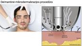 Mechaninių veiksnių taikymas sveikatingumo procedūrose, kosmetologijoje. Dermabrazija 19 puslapis