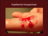 Kraujavimo rūšys ir pirmoji pagalba 4 puslapis