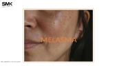 Melasma. Kas tai?