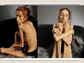 Apie anoreksiją 9 puslapis