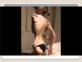 Apie anoreksiją 10 puslapis