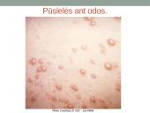 Vėjaraupiai – tai ūminė virusinė liga 11 puslapis