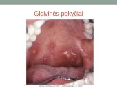 Vėjaraupiai – tai ūminė virusinė liga 12 puslapis