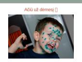 Vėjaraupiai – tai ūminė virusinė liga 13 puslapis