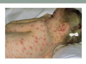 Vėjaraupiai – tai ūminė virusinė liga 3 puslapis