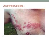 Vėjaraupiai – tai ūminė virusinė liga 5 puslapis