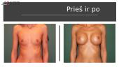 Krūtų didinimo implantais operacija 16 puslapis