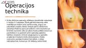 Krūtų didinimo implantais operacija 20 puslapis