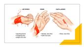 Bleeding (first aid) 4 puslapis