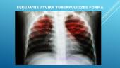 Kvėpavimo organų tuberkuliozė 8 puslapis