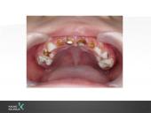 Vaikų odontologijos principai. Ortodontinis gydymas. Dantų vystymasis bei dygimas 12 puslapis