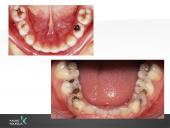 Vaikų odontologijos principai. Ortodontinis gydymas. Dantų vystymasis bei dygimas 19 puslapis