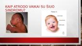 Patau Sindromas  5 puslapis
