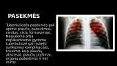 Skaidrės apie tuberkuliozę 4 puslapis