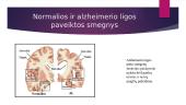 Alzheimerio liga (skaidrės) 3 puslapis