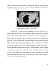 Krūties brachiterapijos gydymas: atvejų lyginamoji analizė 18 puslapis