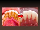 Mineralizuotos dantų apnašos 11 puslapis