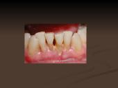 Mineralizuotos dantų apnašos 15 puslapis