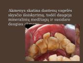 Mineralizuotos dantų apnašos 5 puslapis
