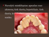 Mineralizuotos dantų apnašos 6 puslapis