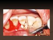 Mineralizuotos dantų apnašos 10 puslapis