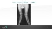 Genu varum valgus ir kineziterapija 4 puslapis