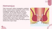 Opaligė, gastroezofaginis refliuksas ir hemorojus 6 puslapis