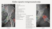 Rentgenologinis klubo sąnario ir šlaunikaulio tyrimas 4 puslapis