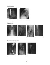 Stemplės susiaurėjimų priežastys ir rentgeno diagnostika 6 puslapis