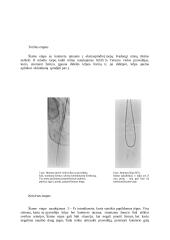 Subintimalinė arterijų rekanalizacija – alternatyva chirurginiam apatinės galūnės lėtinės okliuzijos gydymui 8 puslapis