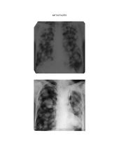 Periferinių plaučių navikų rentgenodiagnostika 8 puslapis