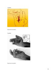 Diupiuitreno kontraktūra 16 puslapis