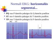 Elektrokardiografija (EKG) 16 puslapis