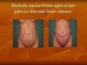 Pilvo sienos operacijos. Riebalų atsiurbimas iš įvairių kūno vietų 13 puslapis