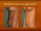 Pilvo sienos operacijos. Riebalų atsiurbimas iš įvairių kūno vietų 20 puslapis