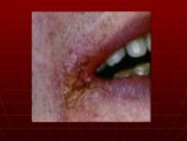 AIDS – pasaulio maras 18 puslapis