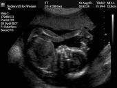 Akušerinė echoskopija 11 puslapis