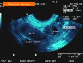 Akušerinė echoskopija 14 puslapis