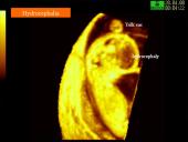 Akušerinė echoskopija 15 puslapis