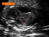 Akušerinė echoskopija 17 puslapis