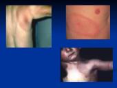 Borrelia burgdorferi 7 puslapis