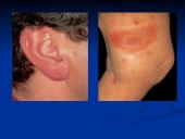 Borrelia burgdorferi 8 puslapis