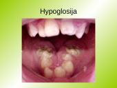 Hyperglosija ir hypoglosija 6 puslapis