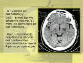 Stereotaksinis metodas 16 puslapis