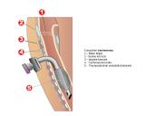 Tracheostomija 4 puslapis