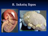 Trombozės rizikos veiksniai 16 puslapis