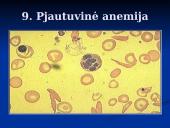 Trombozės rizikos veiksniai 17 puslapis