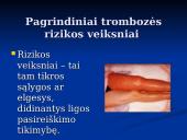 Trombozės rizikos veiksniai 3 puslapis