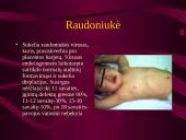 Intrauterinės infekcijos 20 puslapis